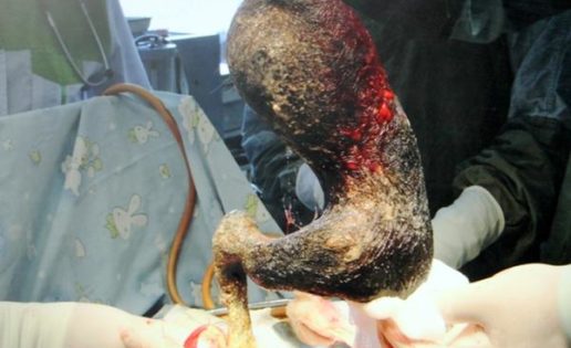 Bola de pelos de 4 kilos es extraída del estómago de una joven
