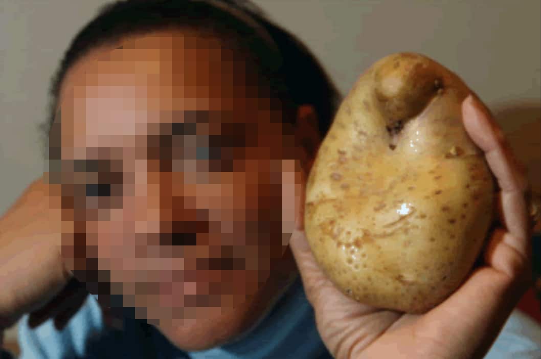 A una mujer de Colombia le creció una patata en la vagina