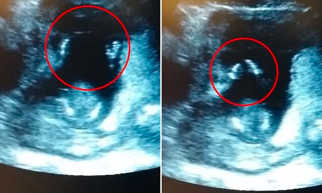 Un feto de 14 semanas aplaude una canción durante la ecografía