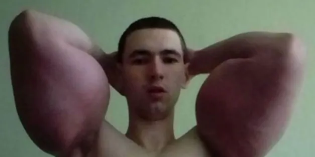 Un joven ruso se inyecta aceite en los brazos para ser como Popeye