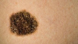 Descubren una relación entre los melanomas y la materia oscura