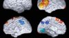 El cerebro de las personas con riesgo de Alzheimer se desarrolla de forma distinta