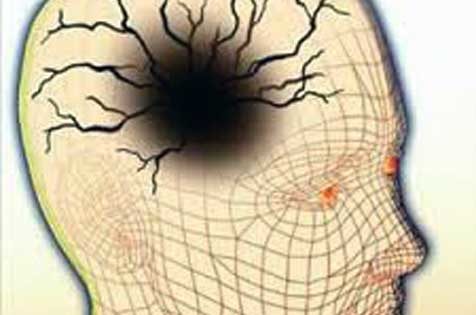 En el cerebro, después de la calma viene la tempestad… en forma de jaqueca