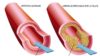 La arteriosclerosis, incluso sin síntomas, daña el cerebro