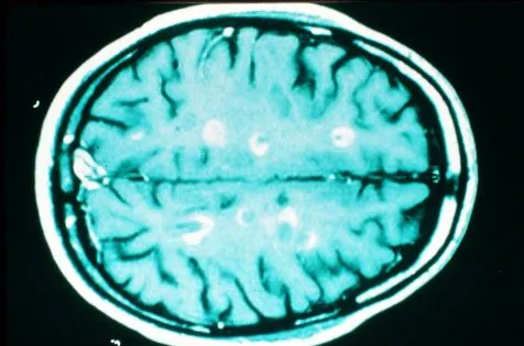 Esclerosis múltiple: La pérdida de volumen cerebral, buen marcador de discapacidad