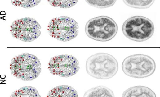 Alzheimer: el cambio en las conexiones neuronales, posible marcador