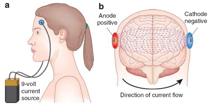 Ictus: Estimulación eléctrica para potenciar la recuperación