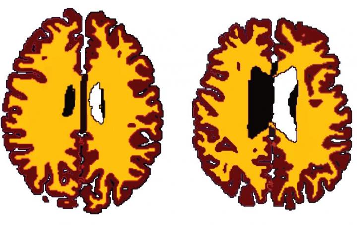 La obesidad también afecta al cerebro