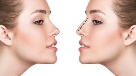¿Sabéis que se puede remodelar la nariz solo con ácido hialurónico?
